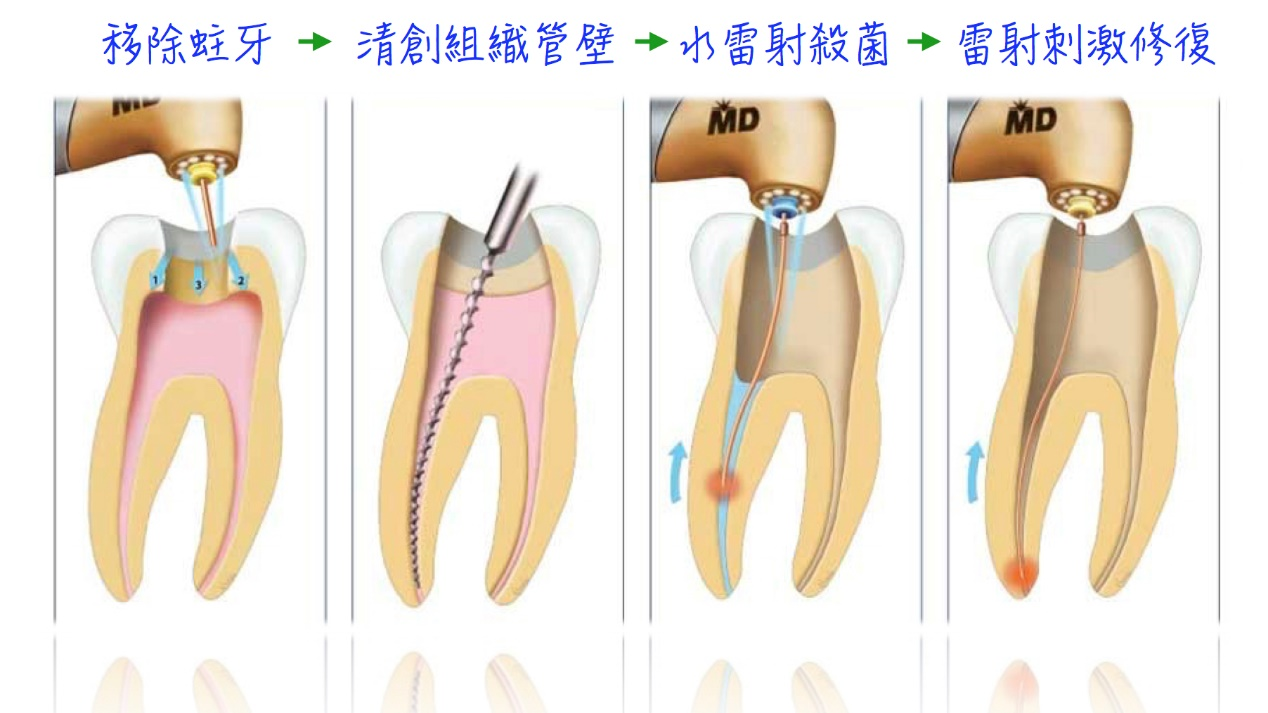 根管治療